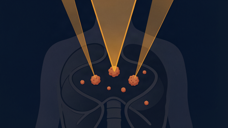 Ilustración de portada: Cuando el cáncer viaja poco: tratar las metástasis con radioterapia además del tratamiento sistémico mejora la supervivencia libre de progresión (ensayo EXTEND)